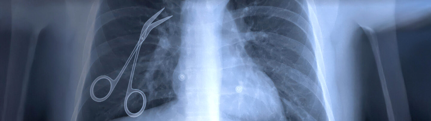 X-ray image of a human chest showing a pair of surgical scissors left inside the upper left side of the chest cavity.