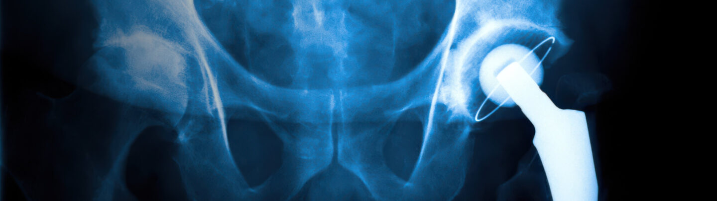 X-ray image showing a hip joint replacement, with a metal prosthetic implant visible in the right hip socket against the bones of the pelvis.