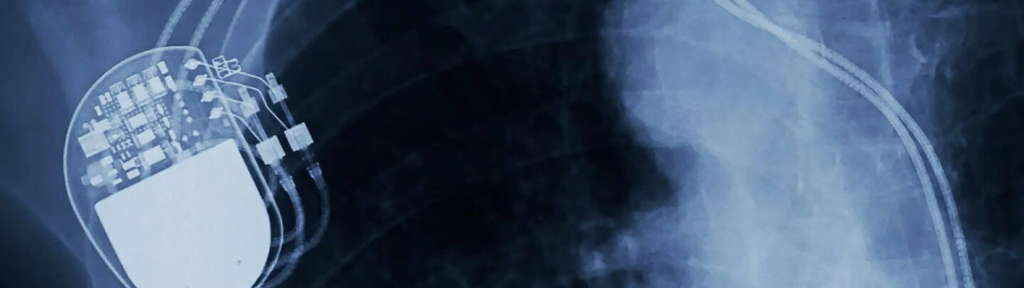 X-ray image showing a medical pacemaker device implanted in the chest, with wires extending into the heart area.